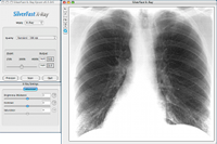 XRay_Lung_small